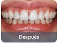 Implante después