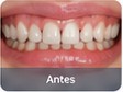 Implante antes