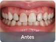 Ortodoncia antes